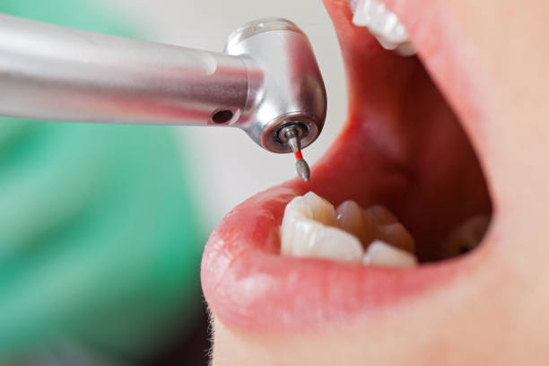 Best Emergency Wisdom Tooth Extraction in Cumberland Head, NY